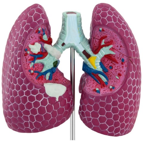 Model anatomiczny 3D płuca człowieka ze zmianami chorobowymi Model anatomiczny 3D płuca człowieka ze zmianami chorobowymi