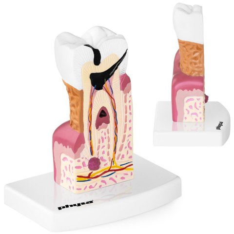 Model anatomiczny chorego zęba człowieka w skali 6:1 Model anatomiczny chorego zęba człowieka w skali 6:1