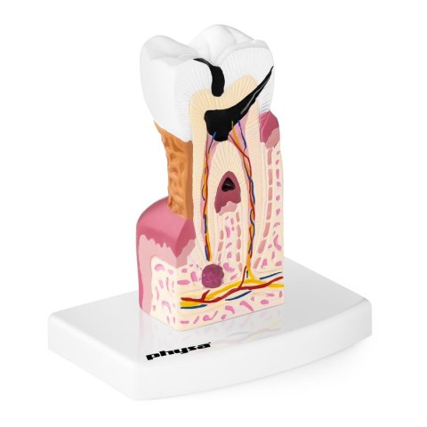 Model anatomiczny chorego zęba człowieka w skali 6:1 Model anatomiczny chorego zęba człowieka w skali 6:1