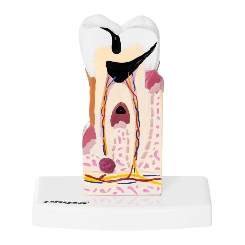 Model anatomiczny chorego zęba człowieka w skali 6:1 Model anatomiczny chorego zęba człowieka w skali 6:1